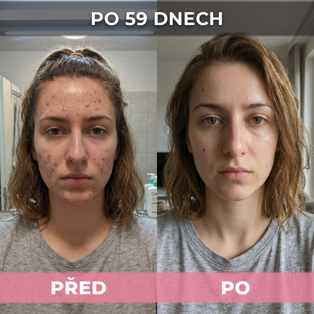 AkneMax (Extrémně rychle odstraňuje akné, pupínky a černé tečky během pouhých několika dnů)