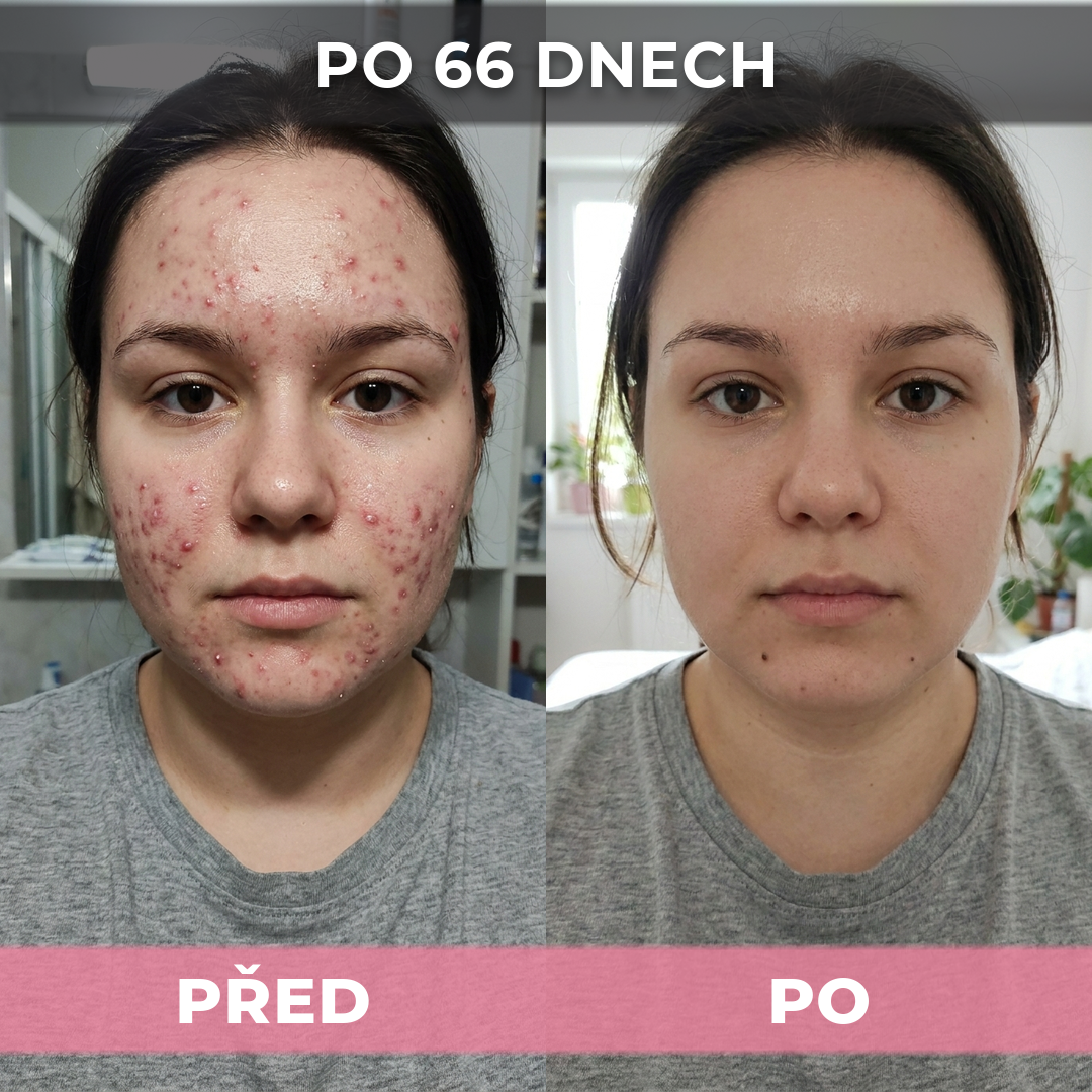 AkneMax (Extrémně rychle odstraňuje akné, pupínky a černé tečky během pouhých několika dnů)