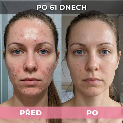 AkneMax (Extrémně rychle odstraňuje akné, pupínky a černé tečky během pouhých několika dnů)