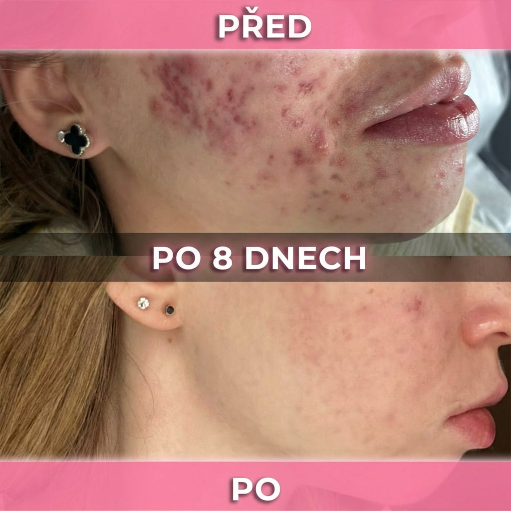 3 ks AkneMax (Extrémně rychle odstraňuje akné, pupínky a černé tečky během pouhých několika dnů)