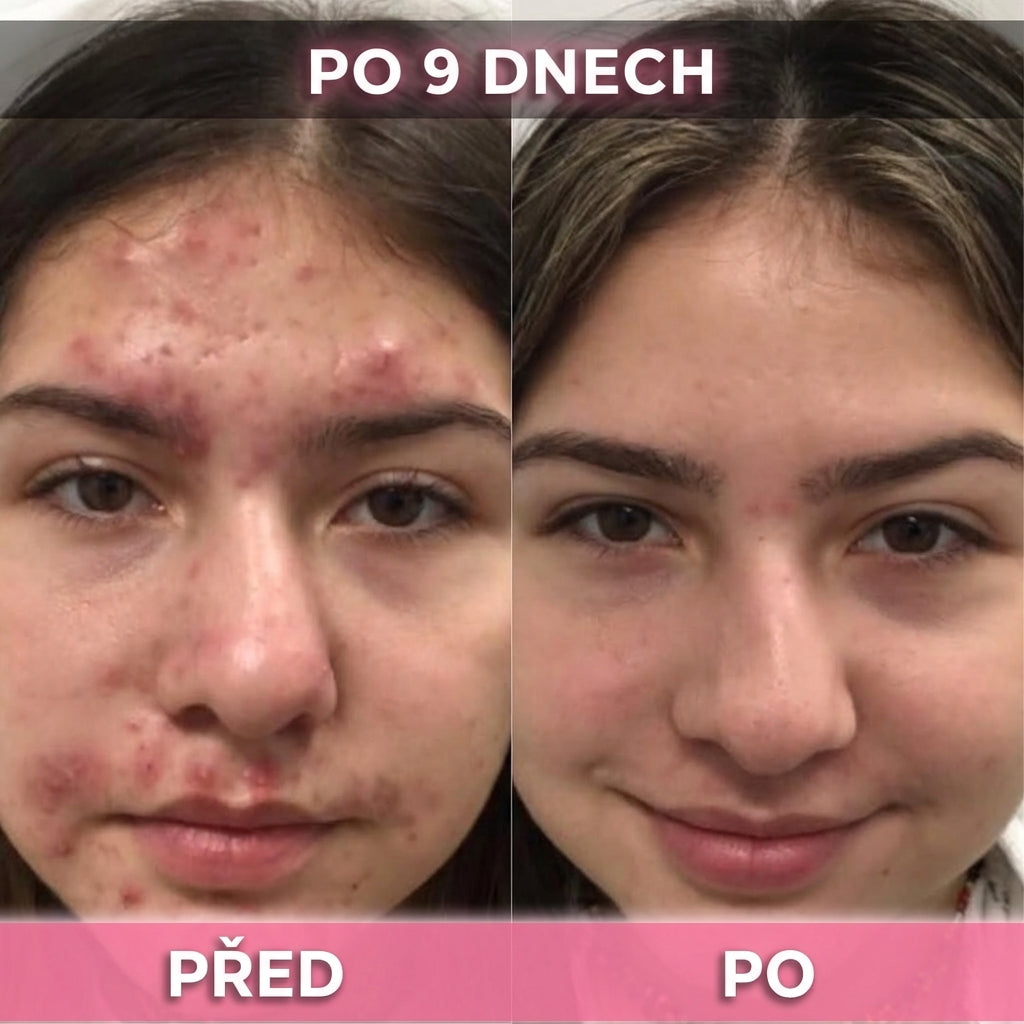 3 ks AkneMax (Extrémně rychle odstraňuje akné, pupínky a černé tečky během pouhých několika dnů)